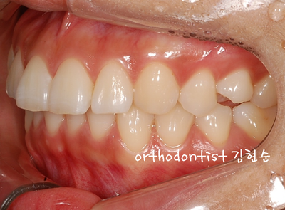 돌출 교정 (비발치 교정/비대칭) 관련 이미지 8