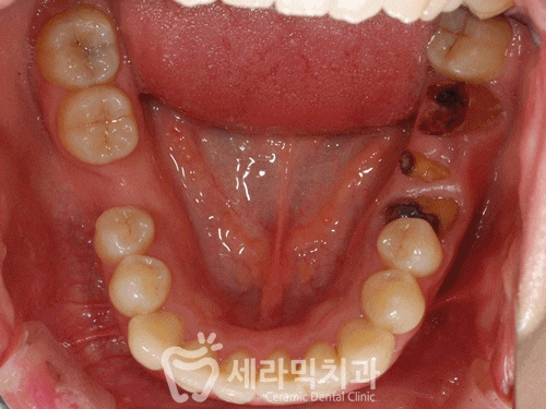 돌출입, 치열불규칙, 치아상실 치아교정과 임플란트 전후 관련 이미지 10