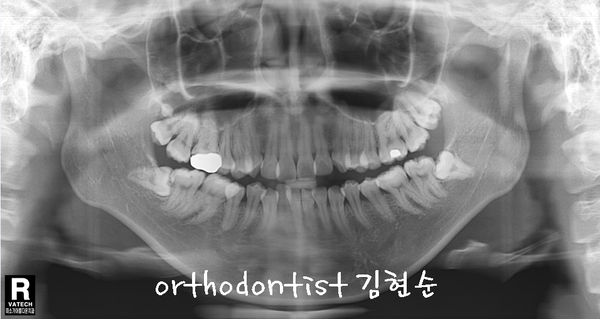 치열 교정(치열 불규칙) 관련 이미지 13