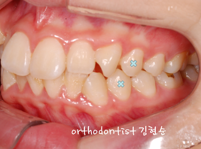 강남 돌출 (토끼 치아) 관련 이미지 17