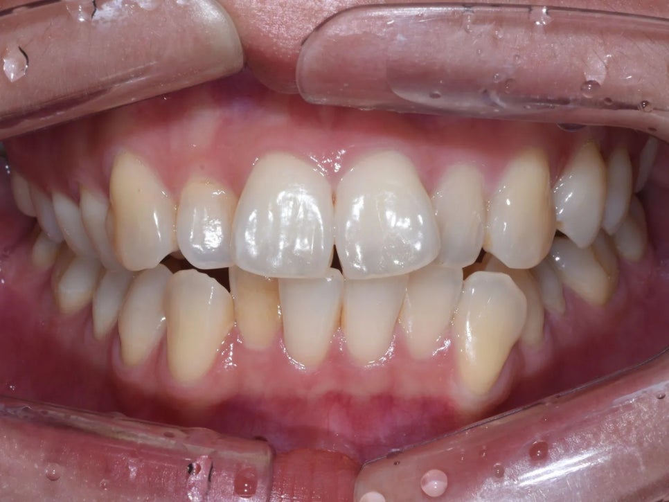세라믹 치과, 삐뚤빼뚤한 치아를 교정 없이 라미네이트로 치료한 사례 관련 이미지 3