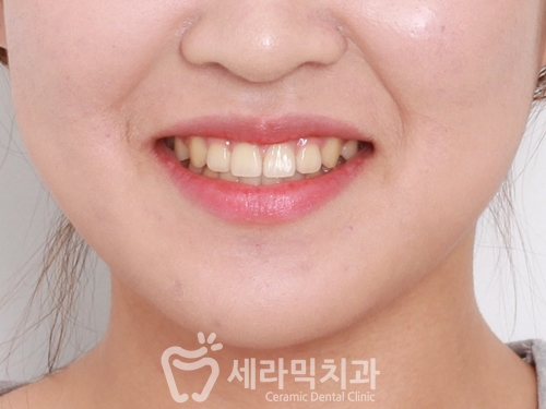 돌출입교정으로 갸름한 턱라인까지 되찾다! 돌출입 치아교정전후 관련 이미지 17