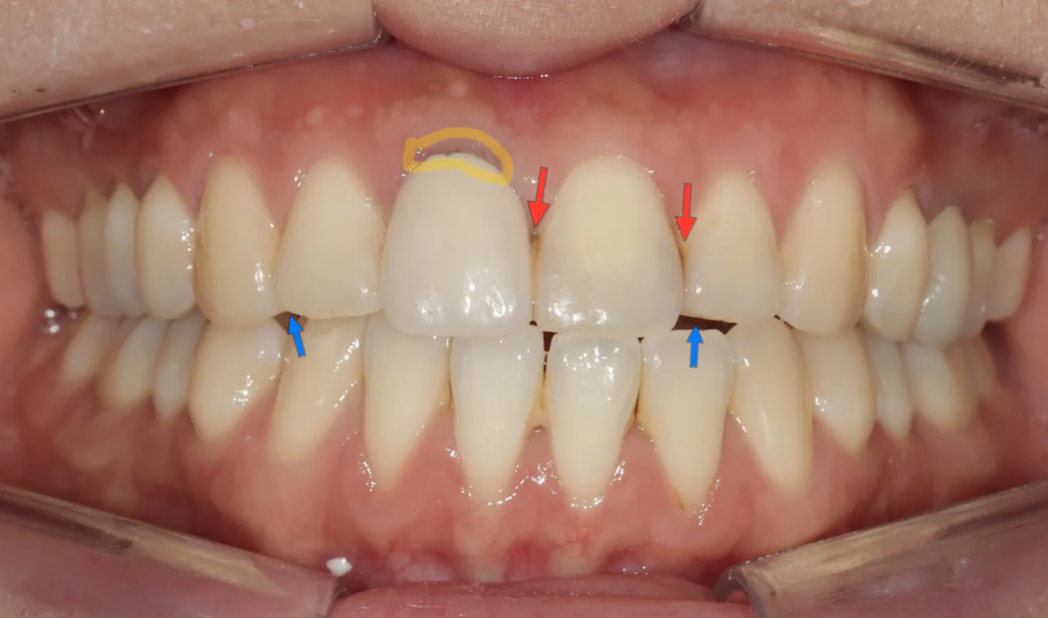 A Case of Improving the Smile Line Along with Replacing a Front Tooth Crown image 4