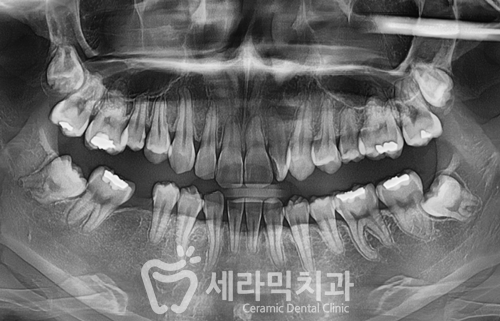 딥바이트(과개교합) 때문에 감추고 싶던 치아, 치아교정전후 달라진 미소 관련 이미지 4