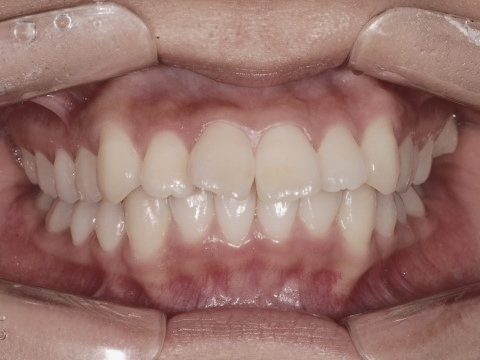 학동역치과 하면 세라믹교정 ~ 관련 이미지 14