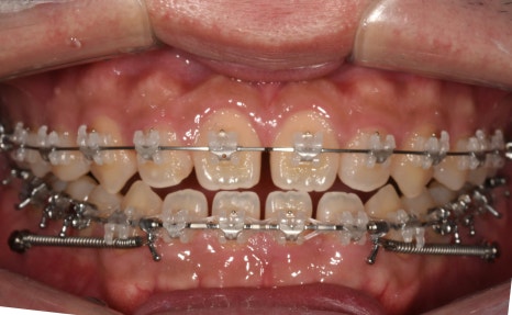 치아가 반대로 물리는 관련 이미지 10