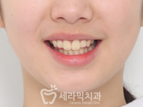 돌출입교정, 심미성과 치아 건강을 동시에 해결! 관련 이미지 6