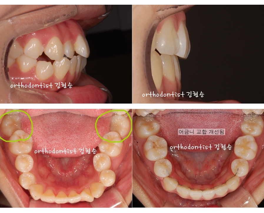 세라믹교정 세라믹치과-돌출입발치교정 4 관련 이미지 5