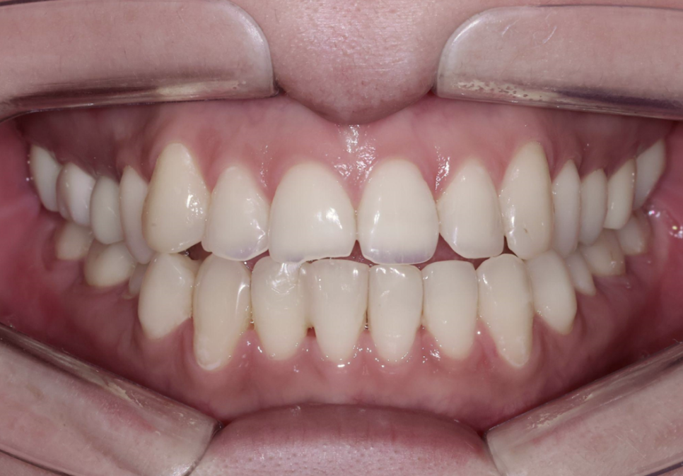 치아부식과 심미성을 동시에 잡은 앞니 치료 (ft. 역류성 식도염) 관련 이미지 7