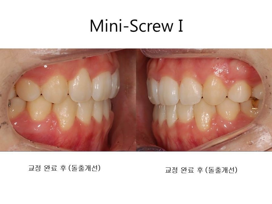 학동역치과 치아교정 잘하는 곳 ! 관련 이미지 18