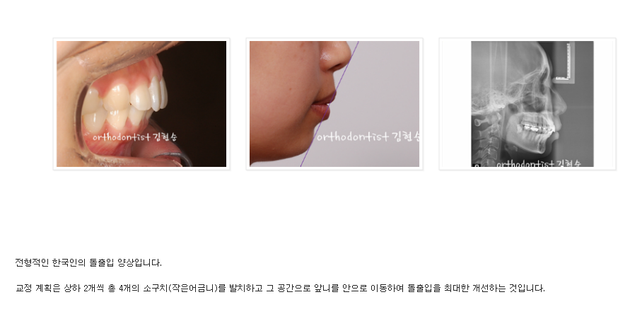 세라믹교정 세라믹치과-돌출입발치교정 7 관련 이미지 3