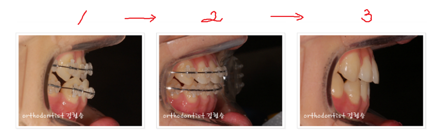 주걱턱수술 안하고 양악수술 안하고 관련 이미지 11