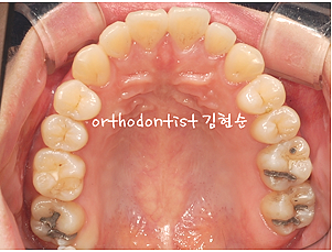 강남 돌출입 교정 관련 이미지 3
