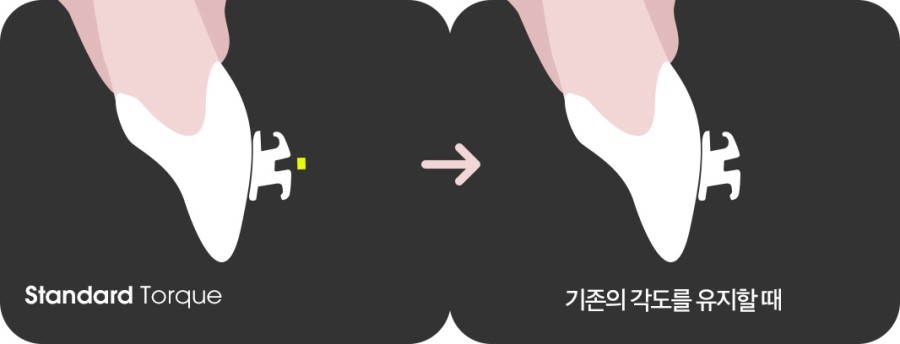 치아각도 교정과정 관련 이미지 7