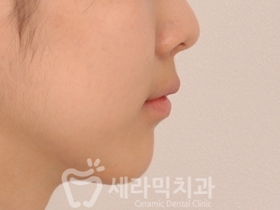 과개교합 치아교정잘하는곳, 세라믹치과 치아교정전후! 관련 이미지 14
