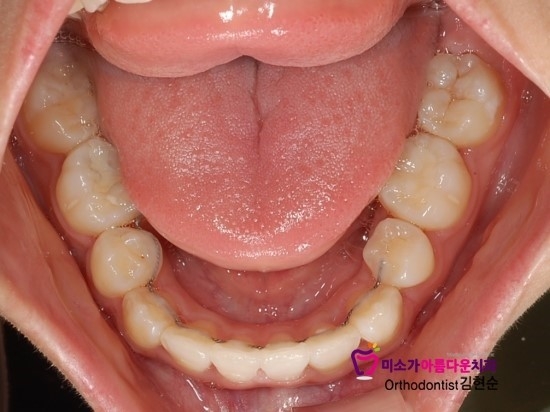 논현동교정잘하는치과 미소가아름다운치과 고객님 후기입니다 관련 이미지 6