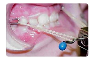 [소아교정/소아교정추천] 어린나이에 교정을 하는 이유는? 관련 이미지 4