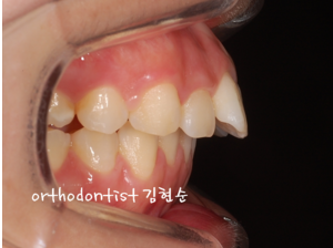 강남 돌출입 교정 관련 이미지 10