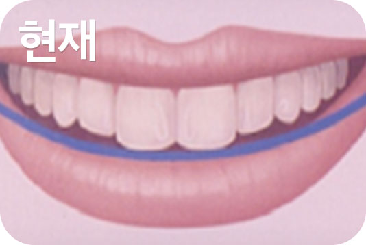 미소모양 치아교정과 스마일아크 관련 이미지 3