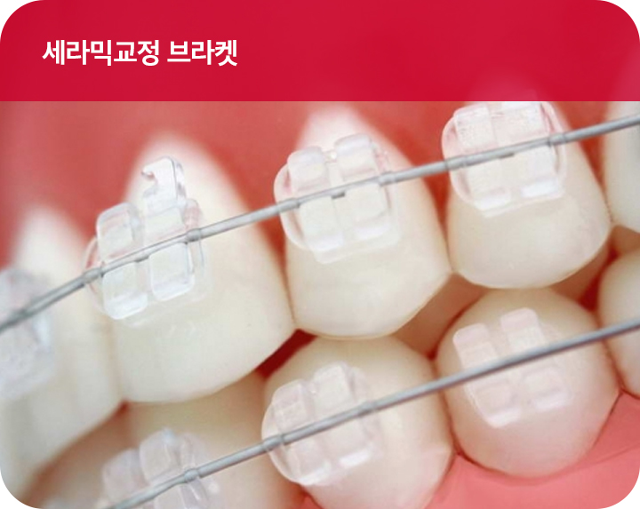 강남치아교정 브라켓비교분석 관련 이미지 7
