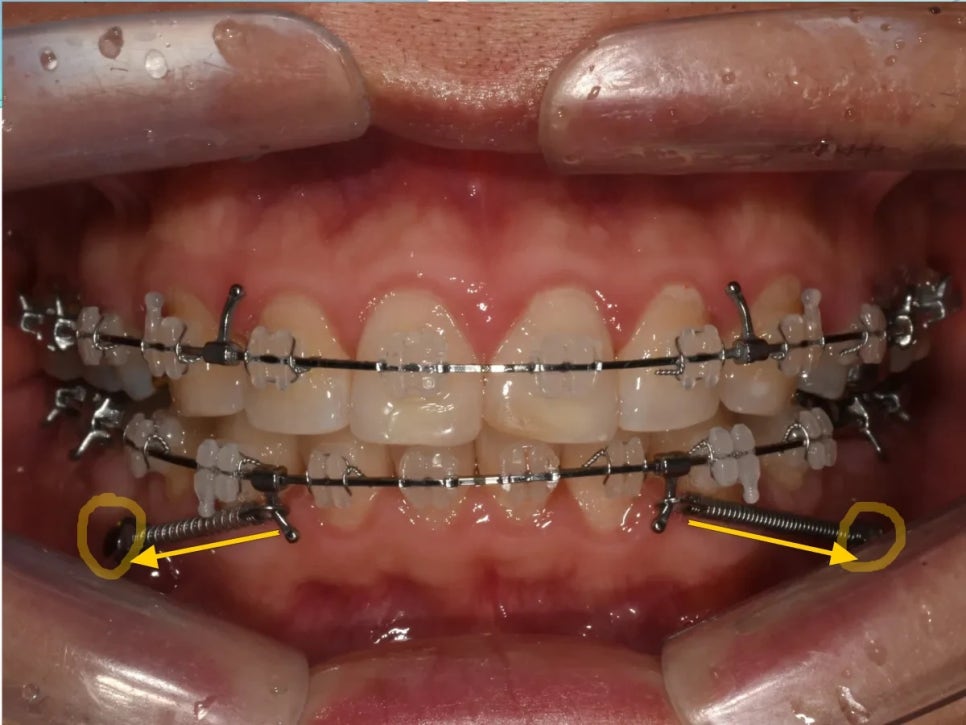 돌출입 재교정, 그것도 세 번째. 관련 이미지 8