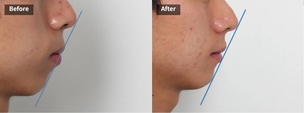 돌출입 교정 전후, 그런데 과개교합까지 있으셨던 환자분 관련 이미지 1