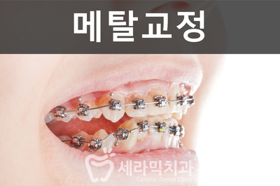 세라믹치과에서 세라믹교정이 인기있는 이유! 관련 이미지 2