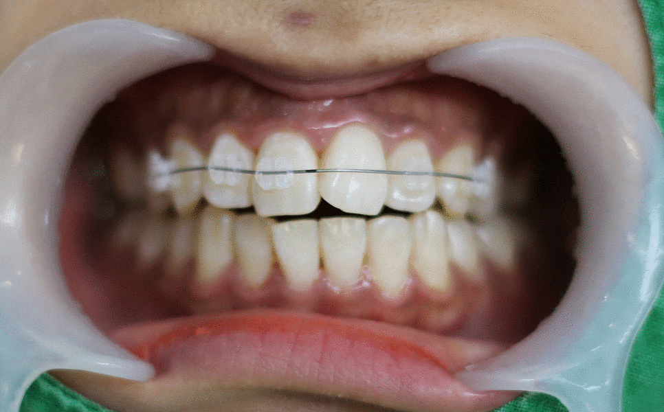 세라믹치과 3M 클래러티 어드밴스 치아교정 전속모델 콘테스트 관련 이미지 16