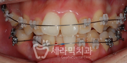 치아교정만으로 세마리 토끼를 한번에! 돌출입, 무턱, 치열불규칙 치아교정전후 관련 이미지 6