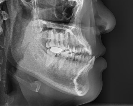치아가 반대로 물리는 관련 이미지 6
