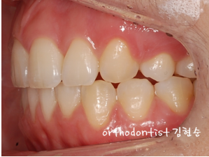 강남 돌출입 교정 관련 이미지 29