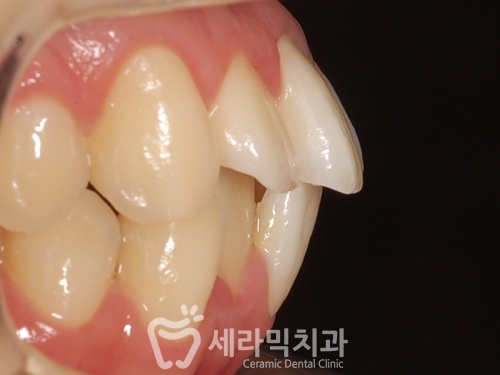 치아교정전후 영상 : 돌출입과 중심선비대칭 인상변화 관련 이미지 3