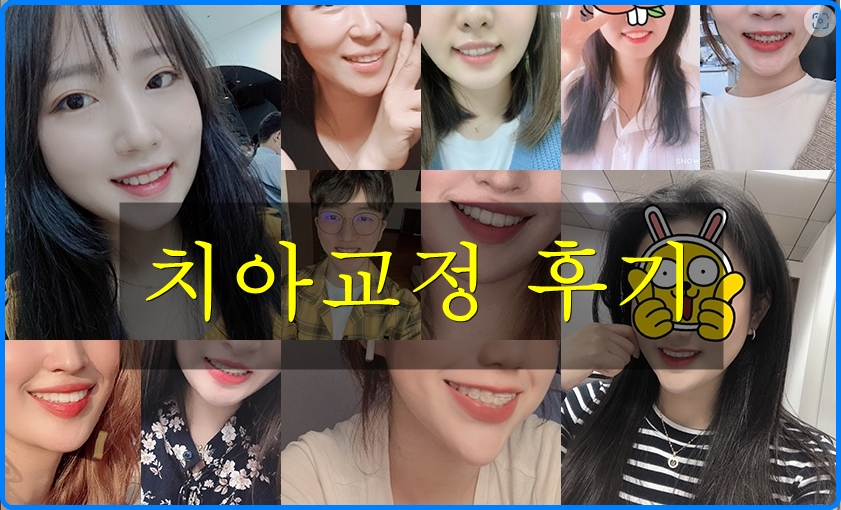 치열불규칙과 돌출입 치아교정전후 턱라인 변화! 관련 이미지 5