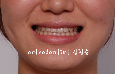 반대 교합 관련 이미지 31