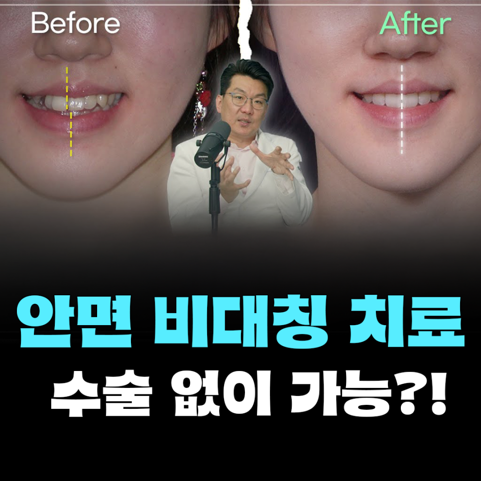 좌우 얼굴비대칭 원인, 문제점, 치료방법 - 비수술 치아교정 관련 이미지 1