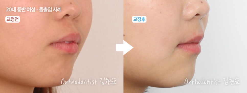 학동역치과 치아교정은 여기서 !! 관련 이미지 21