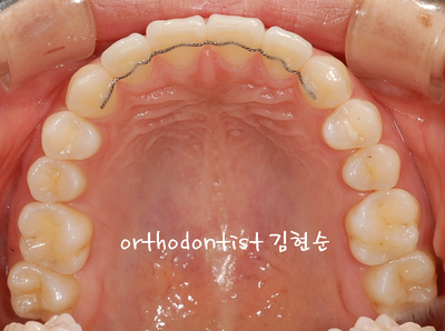 돌출 교정 (비발치 교정/비대칭) 관련 이미지 27