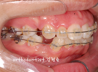 강남 돌출 관련 이미지 22