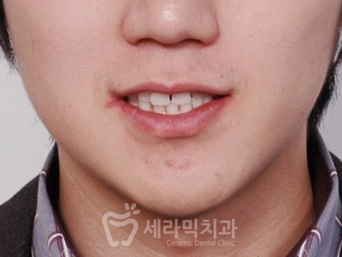 20대 남자 앞니벌어짐 개선사례, 성인 치아교정전후 달라진 Smile~ 관련 이미지 5