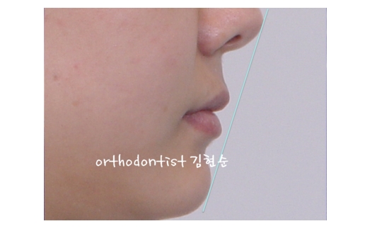 세라믹교정 은 "세라믹 치과 " 관련 이미지 5