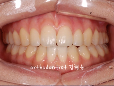 강남교정치과 관련 이미지 14