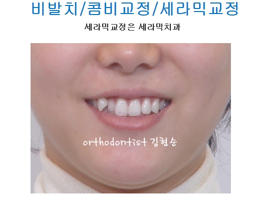 세라믹교정 은 "세라믹 치과 " 관련 이미지 2