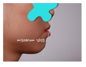 주걱턱교정 수술없이 해결? 관련 이미지 7