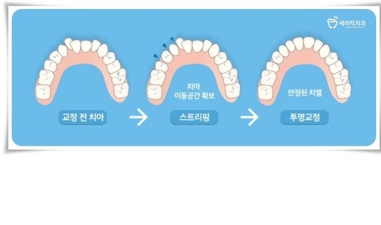 학동역치과 세라믹치과 앞니투명교정 관련 이미지 7