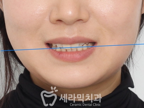 얼굴 비대칭 치아교정전후, 수술 없이 얼마나 개선될까요? 관련 이미지 1
