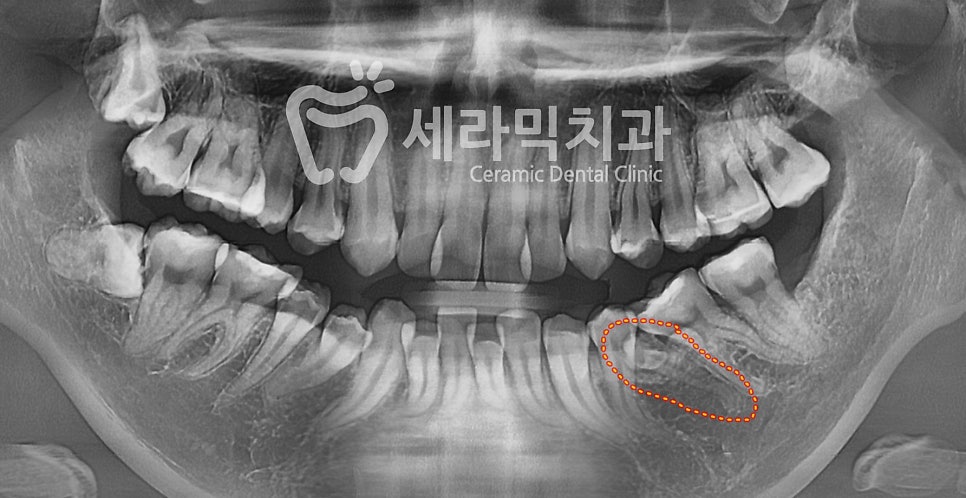 치아교정만으로 세마리 토끼를 한번에! 돌출입, 무턱, 치열불규칙 치아교정전후 관련 이미지 5