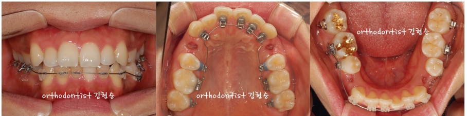 세라믹교정 은 세라믹치과 돌출입발치 관련 이미지 4