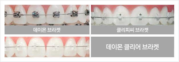 데이몬클리어 vs 클리피씨교정 관련 이미지 12