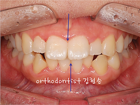 강남 돌출입 교정 관련 이미지 33