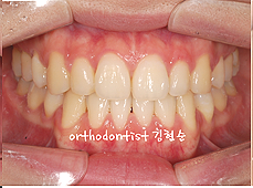 강남 돌출입 교정 관련 이미지 12